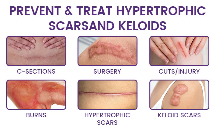 ReGenScar Stem Cell Repair Gel (Improvement in 7 Days) Buy one get one free